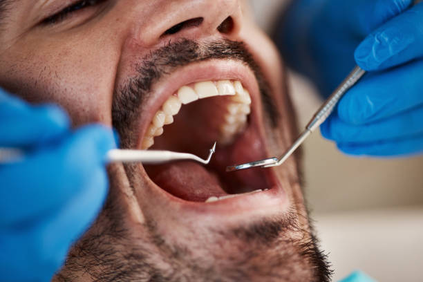 Best Emergency Dental Care for Broken or Chipped Teeth in Staten Island, NY